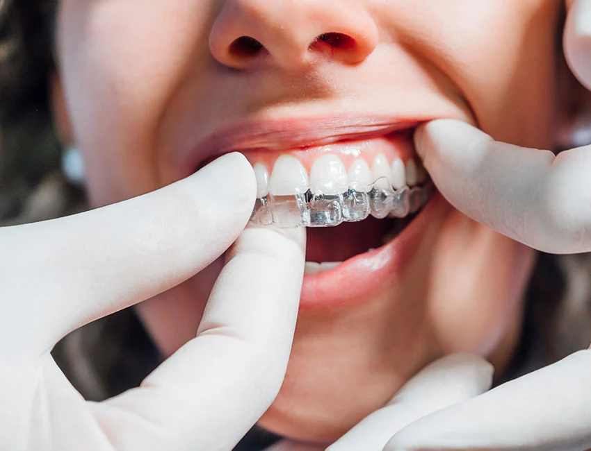 Orthodontics putting Invisalign® for patient in Brentwood, Los Angeles, CA