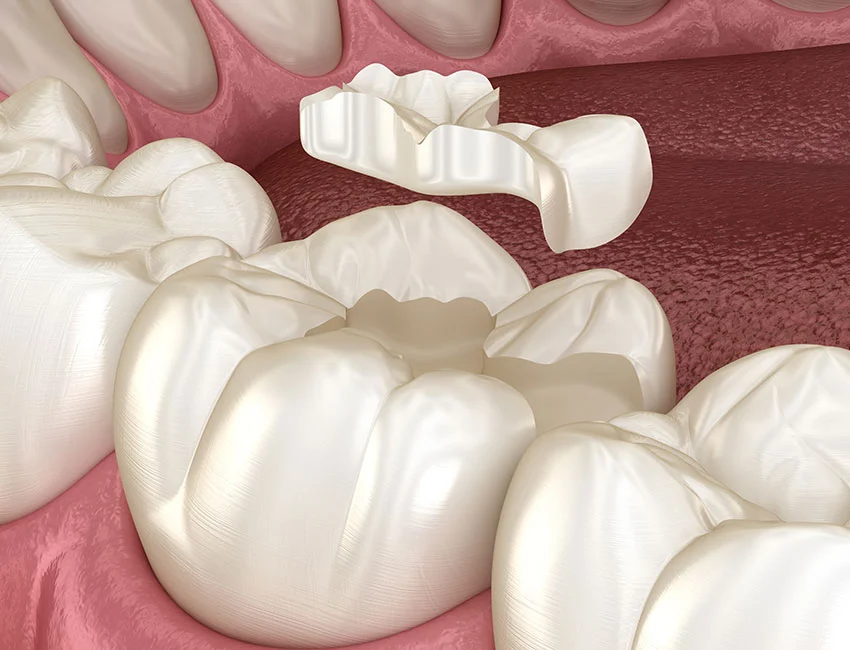 Dental Inlays and onlays or    porcelain fillings