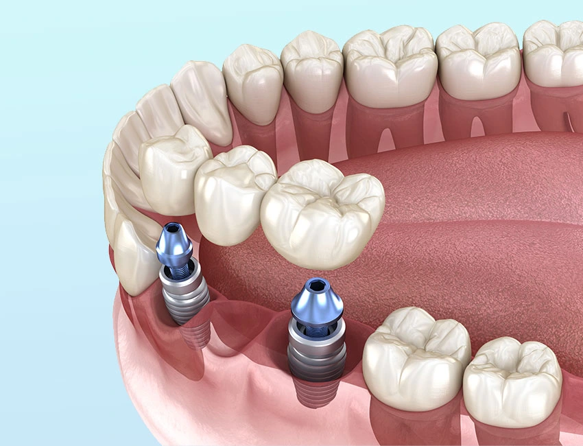 Multi-Tooth Implant Bridges