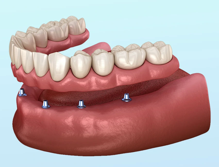 Implant Supported Dentures (Overdentures) or snap-on