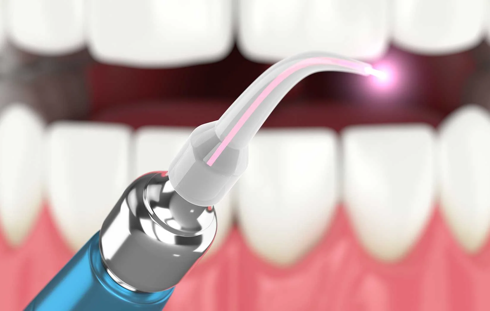 Laser treatment for periodontal disease in Brentwood, Los Angeles, CA
