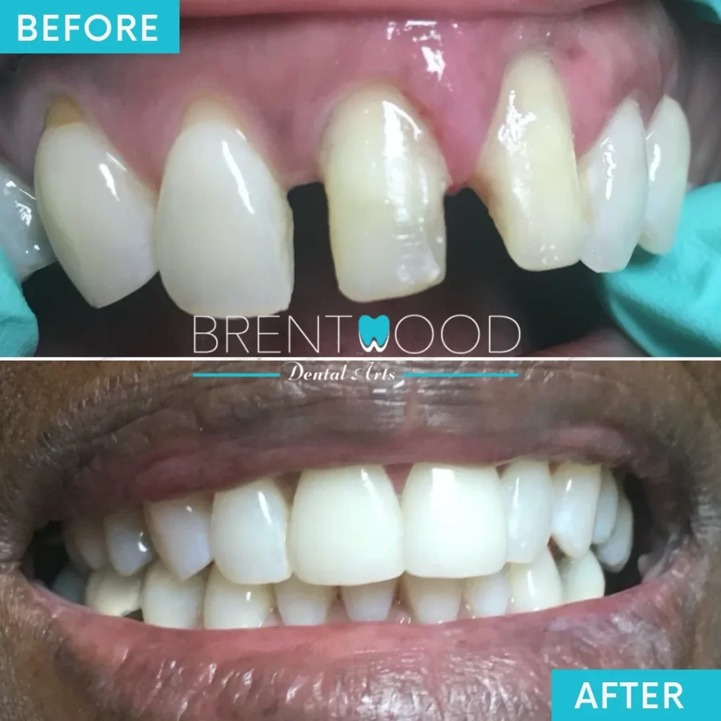 Patients great smile makeover after dental crowns in Brentwood Los Angeles