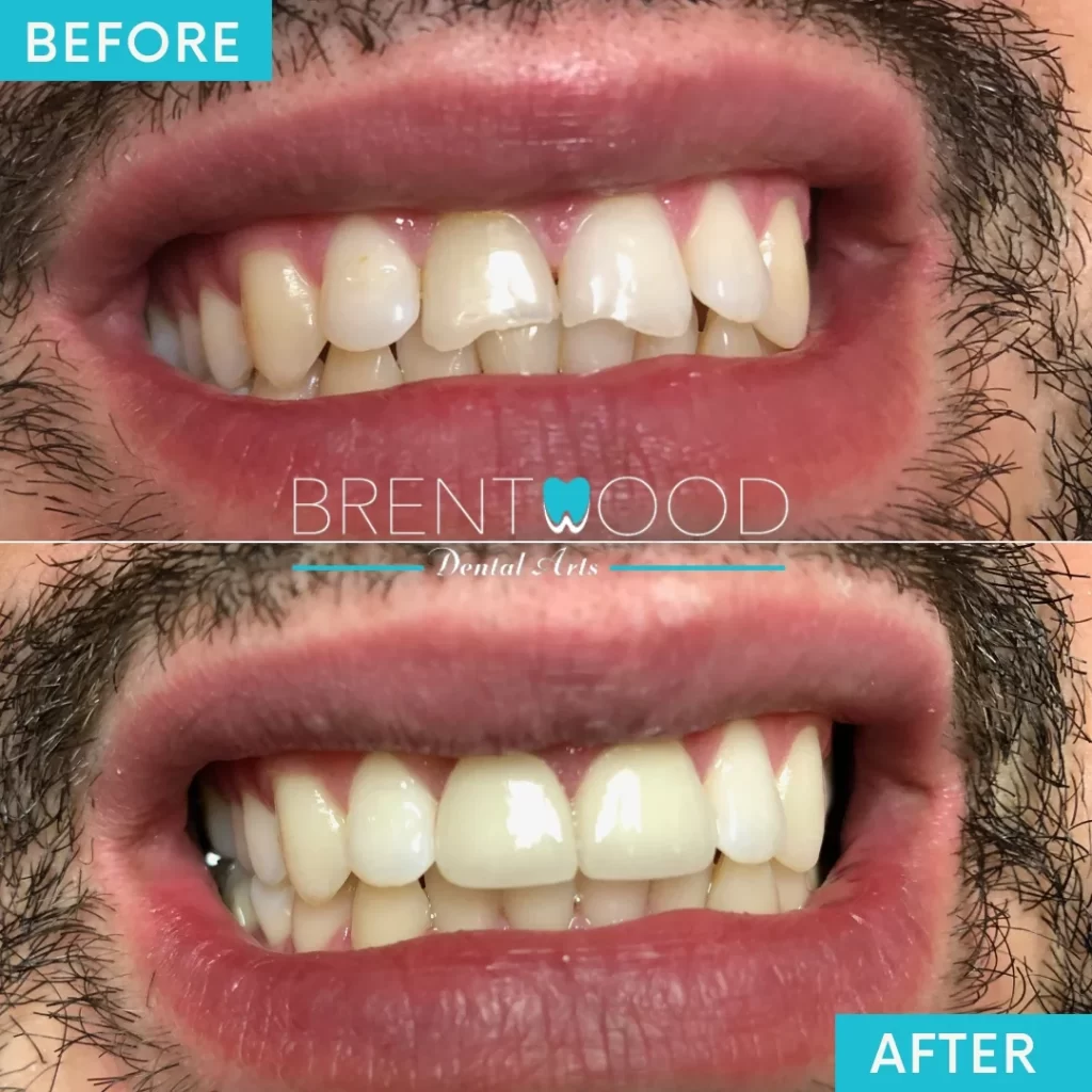 Patients great smile makeover after dental veneers in Brentwood Los Angeles