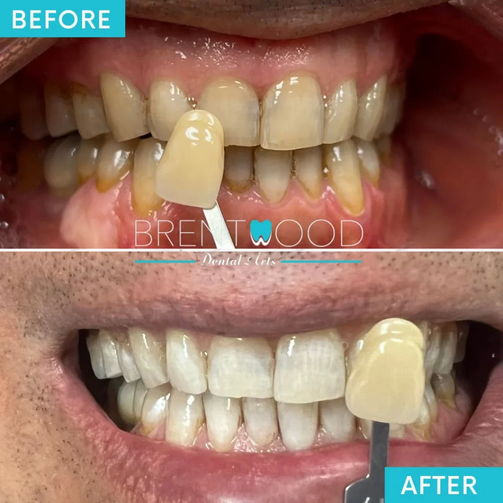 Patients before and after of teeth whitening treatment in Brentwood Los Angeles, CA