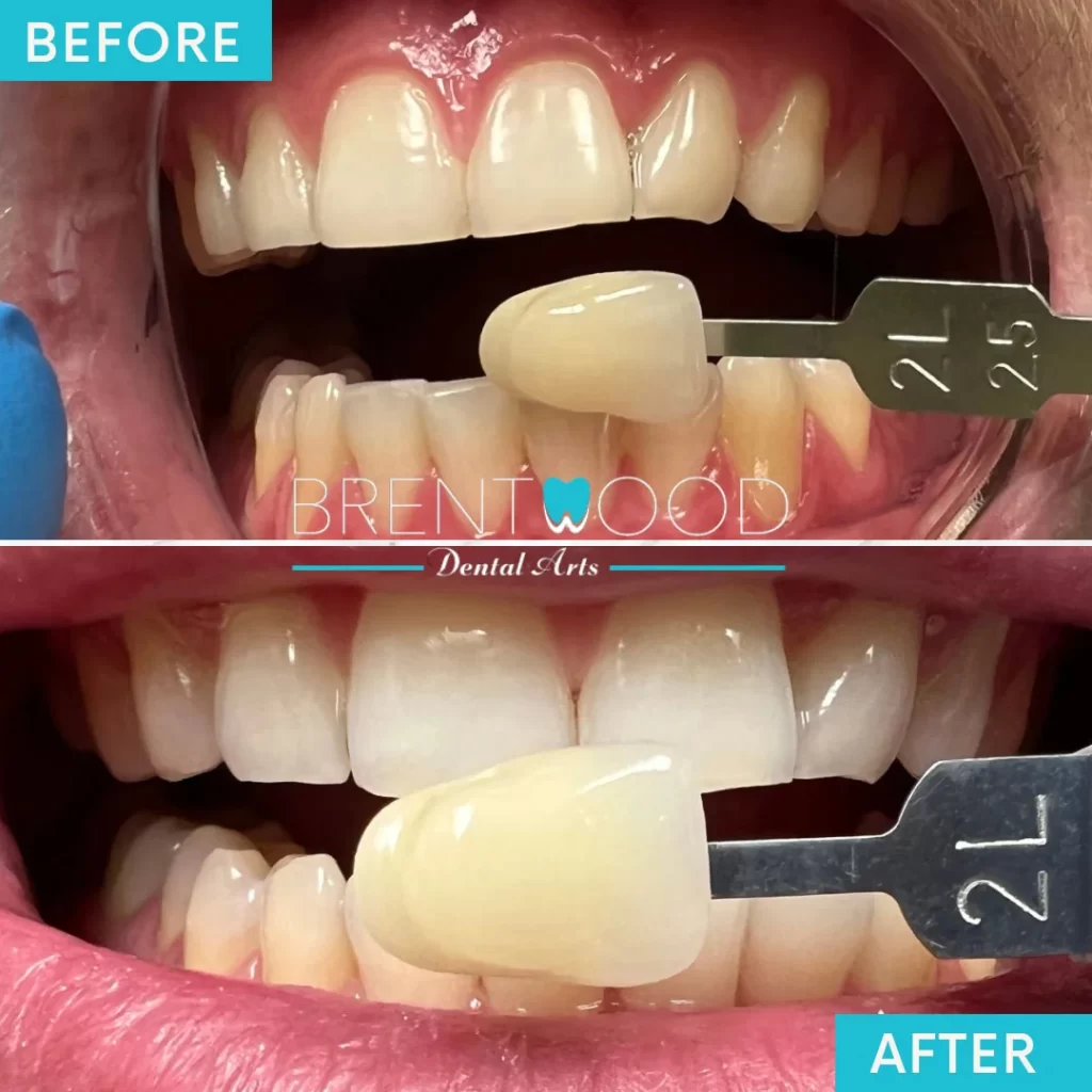 Patients before and after of teeth whitening treatment in Brentwood Los Angeles, CA