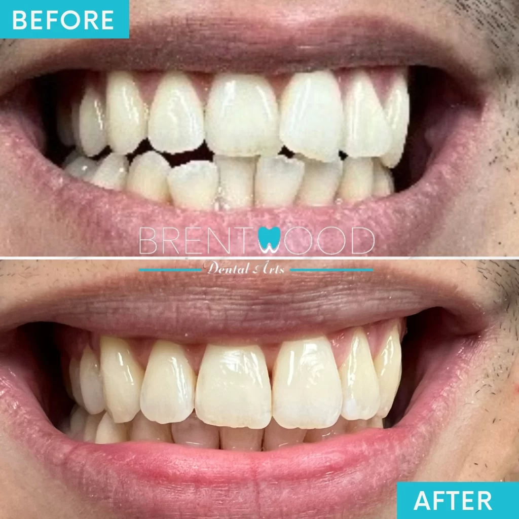 Inveigling before and after patient in Brentwood, CA