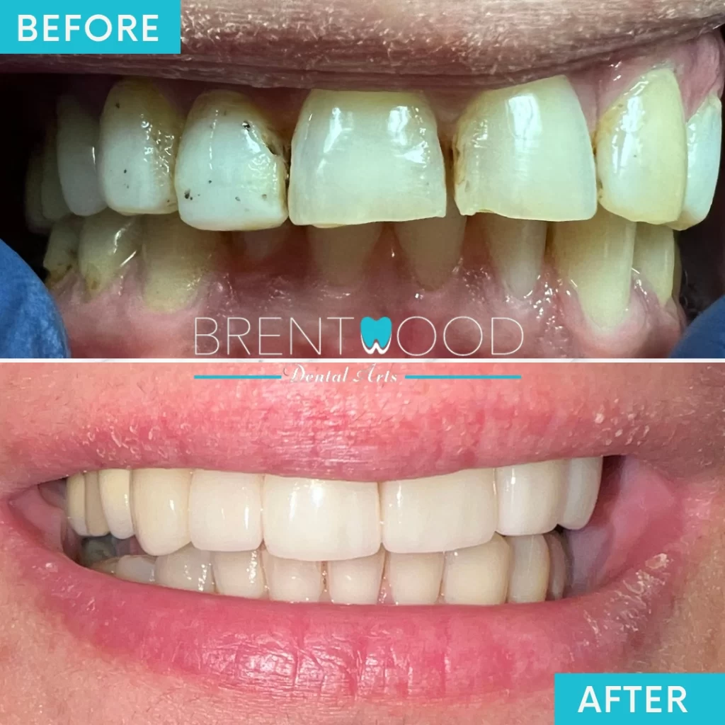 Patient before and after veneers in Brentwood, CA