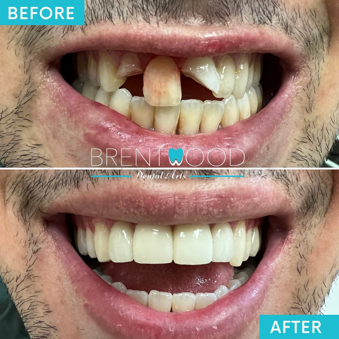 Patient smile makeover in Brentwood, Los Angeles